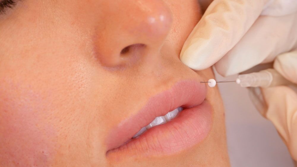 What is Lip Filler? + Frequently Asked Questions