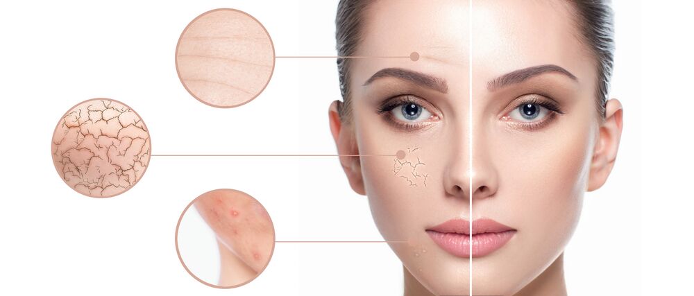 Why Get the MOXI™ Laser During Summer?