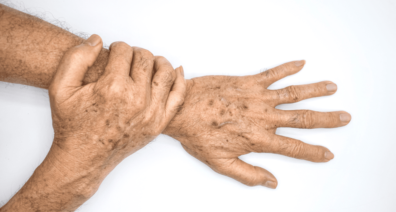 Age Spots / Hyperpigmentation