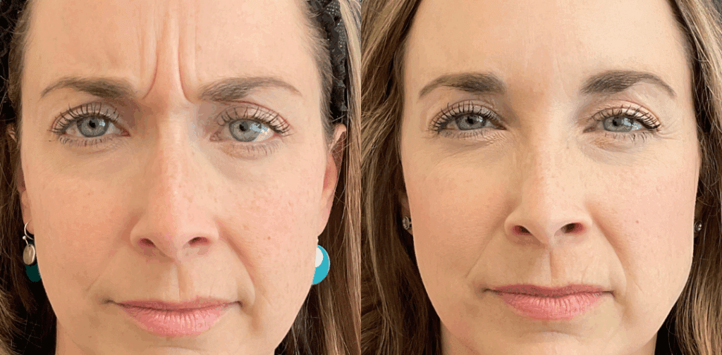 The Ultimate Guide to Fillers for Frown Lines: Choosing the Right Option for You